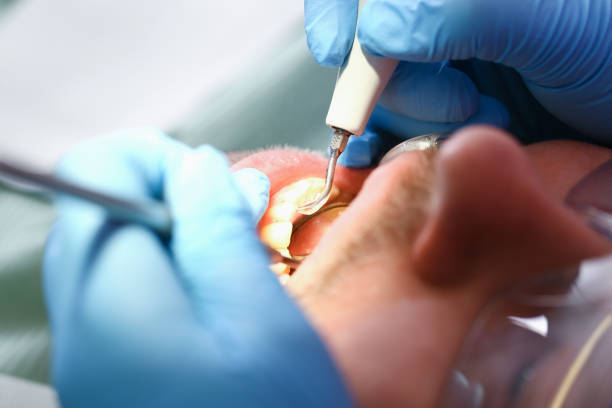 Best Emergency Wisdom Teeth Removal in Vinita, OK